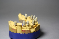Dentallabor Feldmann - Implantatarbeit - Labor 3Implatate - Bild 1