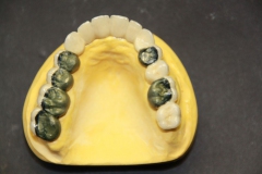 Dentallabor Feldmann - abnehmbare keramisch verblendete Brücke - Bild 4