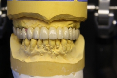 Dentallabor Feldmann - abnehmbare keramisch verblendete Brücke - Bild 6