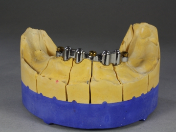 Dentallabor Feldmann - gefräste Stege - Bild 3