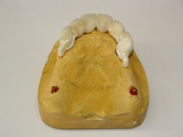 Dentallabor Feldmann - Geschiebe und Riegel  - Bild 1