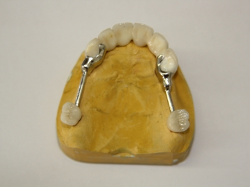 Dentallabor Feldmann - Geschiebe und Riegel  - Bild 2