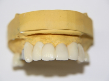 Dentallabor Feldmann - Geschiebe und Riegel  - Bild 3