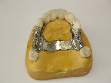 Dentallabor Feldmann - Geschiebe und Riegel  - Bild 4