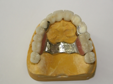 Dentallabor Feldmann - Geschiebe und Riegel  - Bild 6