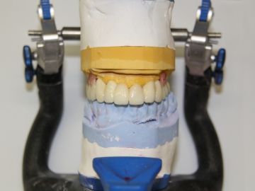 Dentallabor Feldmann - Geschiebe und Riegel  - Bild 7