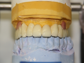 Dentallabor Feldmann - Geschiebe und Riegel  - Bild 8