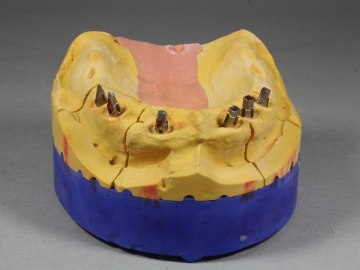 Dentallabor Feldmann - Geschiebe und Riegel  - Bild 9