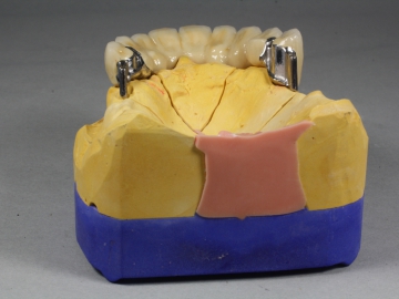 Dentallabor Feldmann - Geschiebe und Riegel  - Bild 12