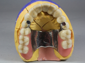 Dentallabor Feldmann - Geschiebe und Riegel  - Bild 13