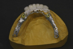 Dentallabor Feldmann - Geschiebearbeit aus Zirkon - Bild 2