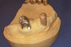 Dentallabor Feldmann - keramische Verblendung und Goldteleskope - Bild 02