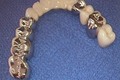 Dentallabor Feldmann - keramische Verblendung und Goldteleskope - Bild 03