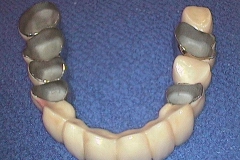 Dentallabor Feldmann - keramische Verblendung und Goldteleskope - Bild 04