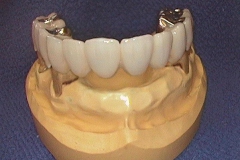 Dentallabor Feldmann - keramische Verblendung und Goldteleskope - Bild 05