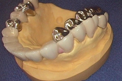 Dentallabor Feldmann - keramische Verblendung und Goldteleskope - Bild 06