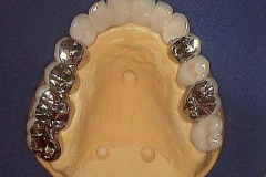 Dentallabor Feldmann - keramische Verblendung und Goldteleskope - Bild 07