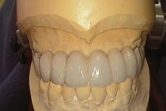 Dentallabor Feldmann - keramische Verblendung und Goldteleskope - Bild 09