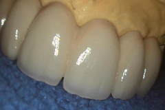 Dentallabor Feldmann - keramische Verblendung und Goldteleskope - Bild 11