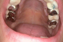 Dentallabor Feldmann - keramische Verblendung und Goldteleskope - Bild 14