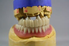 Dentallabor Feldmann - Implantatarbeit - Labor 3Implatate - Bild 3