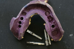 Dentallabor Feldmann - Implantatarbeit - Oberkiefer und Unterkiefer - Bild 2