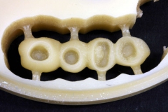 Dentallabor Feldmann - Implantatarbeit - Oberkiefer und Unterkiefer - Bild 7