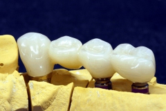 Dentallabor Feldmann - Implantatarbeit - Oberkiefer und Unterkiefer - Bild 11