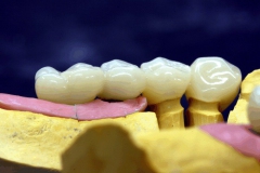 Dentallabor Feldmann - Implantatarbeit - Oberkiefer und Unterkiefer - Bild 12