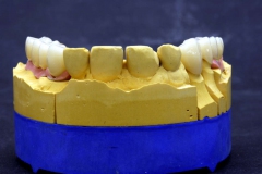 Dentallabor Feldmann - Implantatarbeit - Oberkiefer und Unterkiefer - Bild 13