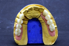 Dentallabor Feldmann - Implantatarbeit - Oberkiefer und Unterkiefer - Bild 14