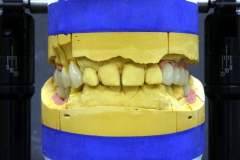 Dentallabor Feldmann - Implantatarbeit - Oberkiefer und Unterkiefer - Bild 15