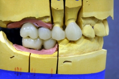 Dentallabor Feldmann - Implantatarbeit - Oberkiefer und Unterkiefer - Bild 16