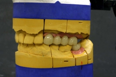 Dentallabor Feldmann - Implantatarbeit - Oberkiefer und Unterkiefer - Bild 17