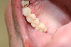 Dentallabor Feldmann - Implantatarbeit - Oberkiefer und Unterkiefer - Bild 21