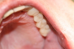 Dentallabor Feldmann - Implantatarbeit - Oberkiefer und Unterkiefer - Bild 22