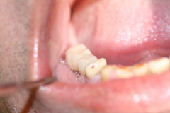 Dentallabor Feldmann - Implantatarbeit - Oberkiefer und Unterkiefer - Bild 23