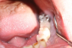 Dentallabor Feldmann - Implantatarbeit - Oberkiefer und Unterkiefer - Bild 24