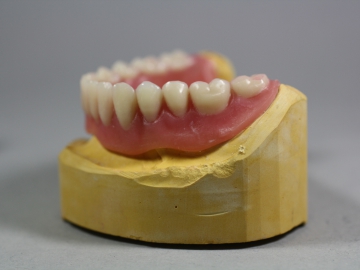 Dentallabor Feldmann - Implantate für besseren Prothesenhalt - Bild 8
