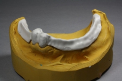 Dentallabor Feldmann - Primärteleskope aus Gold, Galvano, NE, Zirkon - Bild 01