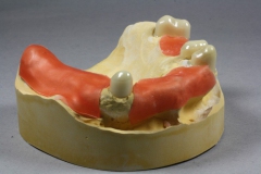 Dentallabor Feldmann - Primärteleskope aus Gold, Galvano, NE, Zirkon - Bild 04