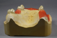 Dentallabor Feldmann - Primärteleskope aus Gold, Galvano, NE, Zirkon - Bild 05