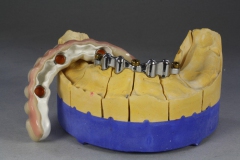 Dentallabor Feldmann - Primärteleskope aus Gold, Galvano, NE, Zirkon - Bild 06