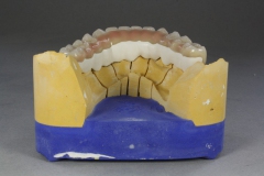 Dentallabor Feldmann - Primärteleskope aus Gold, Galvano, NE, Zirkon - Bild 07