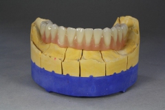 Dentallabor Feldmann - Primärteleskope aus Gold, Galvano, NE, Zirkon - Bild 08