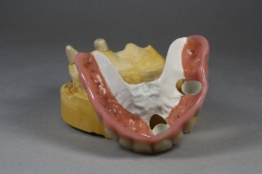 Dentallabor Feldmann - Primärteleskope aus Gold, Galvano, NE, Zirkon - Bild 09