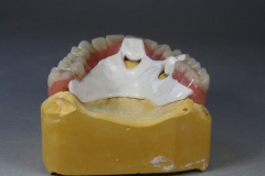 Dentallabor Feldmann - Primärteleskope aus Gold, Galvano, NE, Zirkon - Bild 10