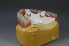 Dentallabor Feldmann - Primärteleskope aus Gold, Galvano, NE, Zirkon - Bild 11