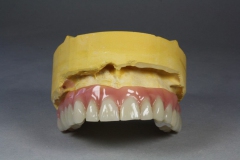 Dentallabor Feldmann - Primärteleskope aus Gold, Galvano, NE, Zirkon - Bild 12