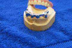 Dentallabor Feldmann - Titan - Stegarbeit gaumenfrei - Bild 1